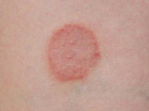 Ringworm on the skin